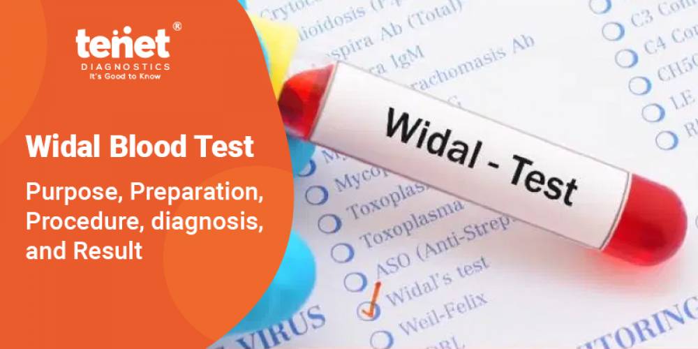 Widal Blood Test- Purpose, Preparation, Procedure, diagnosis, and Result image