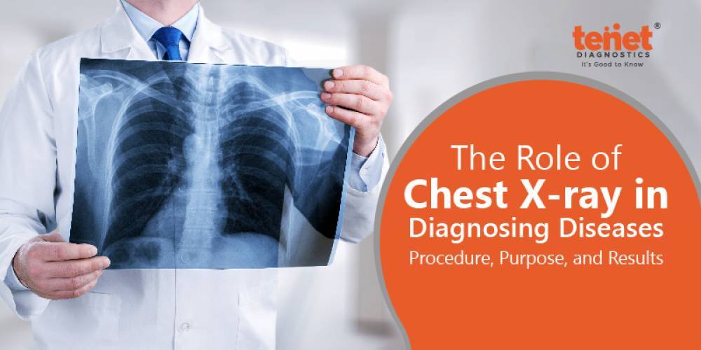 The Role of Chest X-ray in Diagnosing Diseases image