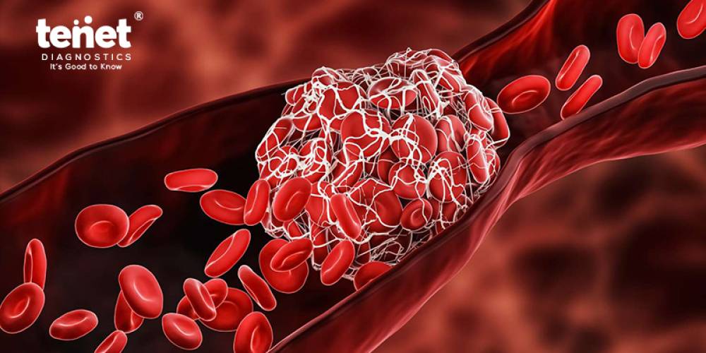 All About Thrombophilia Profile Test image