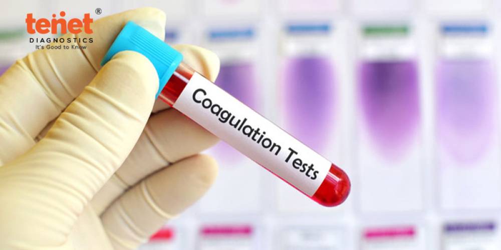 Understanding Coagulation Profile Tests image