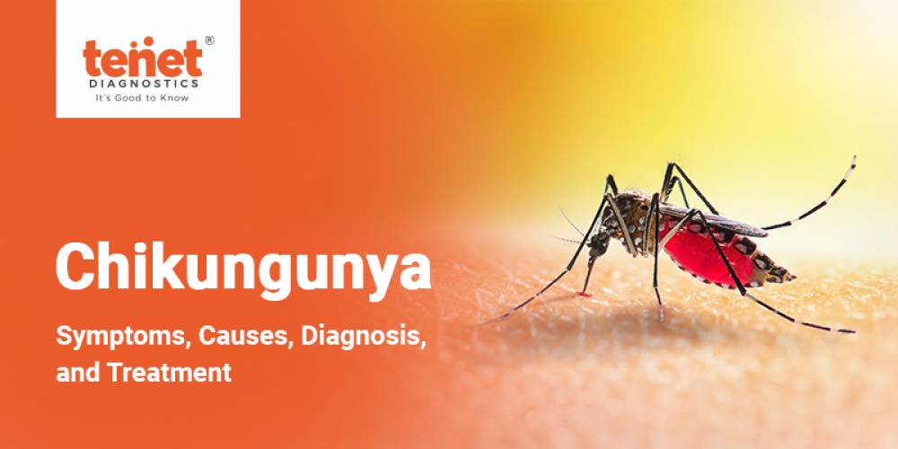 Chikungunya: Symptoms, Causes, Diagnosis, and Treatment image